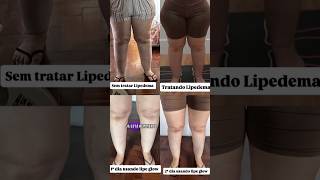 ESSE CREME MELHOROU MEU LIPEDEMA!