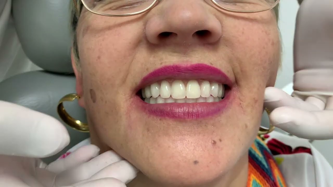 My First Reaction With My New Teeth Was Very Fun!