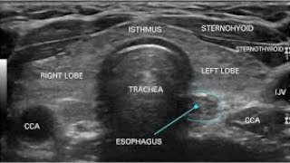 Thyroid ultrasound-tips and tricks