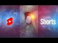 What is Lumbar Disc Herniation? | Herniated Disc #Shorts