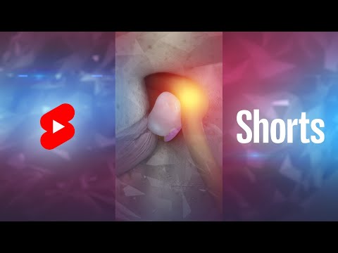 Vídeo: On se sent el dolor de disc herniat?