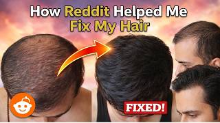 Reddit Told Me to Try Minoxidil & Finasteride | Here’s My Hair Now