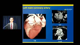 Cardiac CT Normal Anatomy and Variants