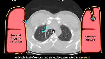 Chest Radiology: The Azygous Fissure, a normal variant