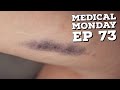 Medical Monday Ep 73: Skin Pressure Injuries Part 6