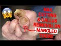 NAIL CUTTING AND CALLUS REMOVAL ON MANGLED TOES