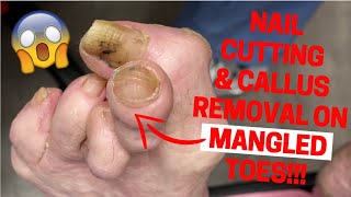 NAIL CUTTING AND CALLUS REMOVAL ON MANGLED TOES