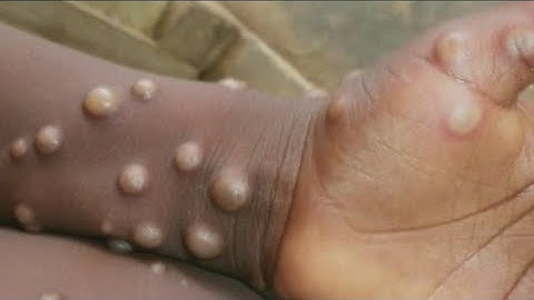 US buying more Monkeypox vaccines