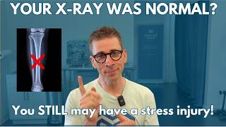 Your X-Ray Was Normal… But You May STILL Have a Stress Fracture