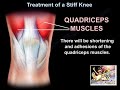 Treatment Of A Stiff Knee - Everything You Need To Know - Dr. Nabil Ebraheim