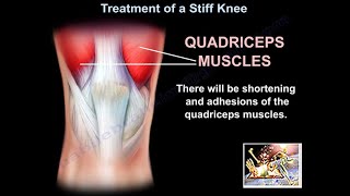 Treatment Of A Stiff Knee - Everything You Need To Know - Dr. Nabil Ebraheim screenshot 1