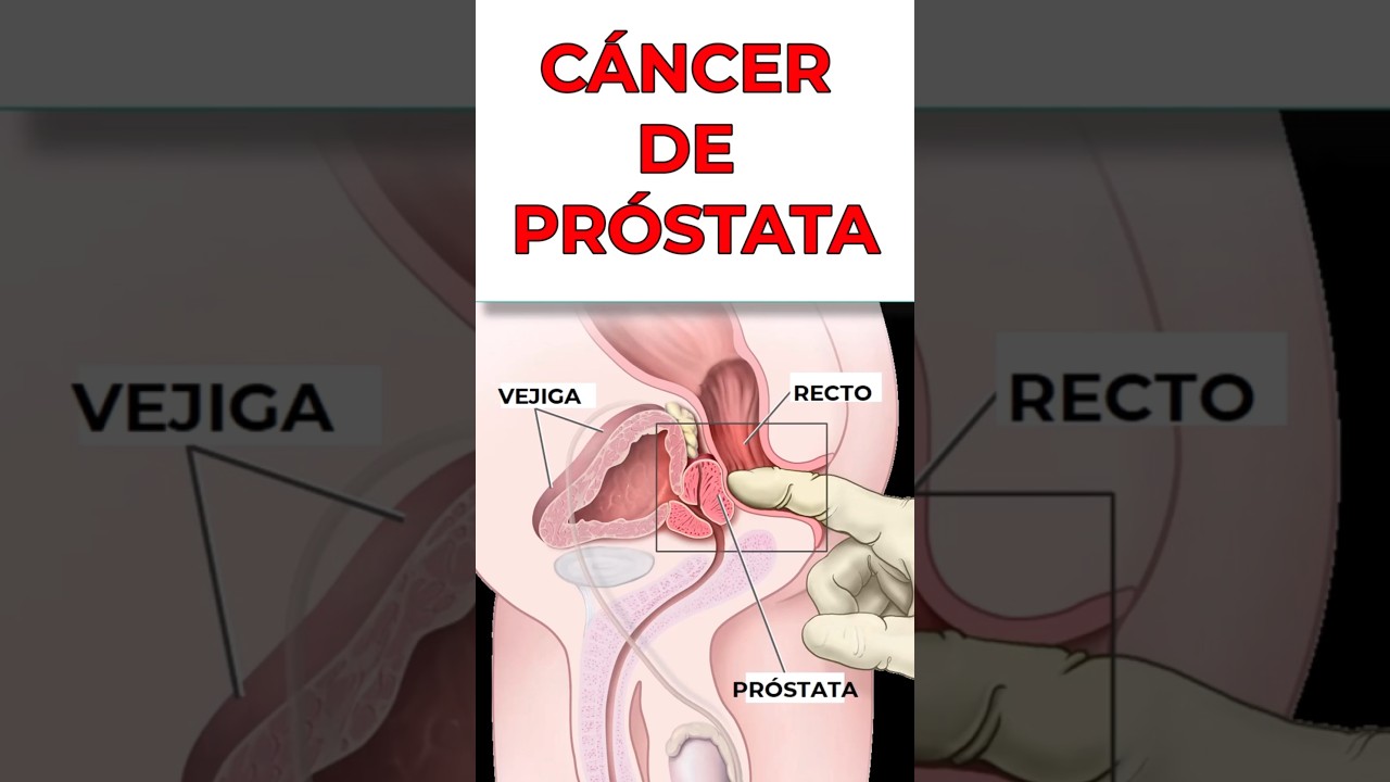 3 Lecciones del cáncer próstata