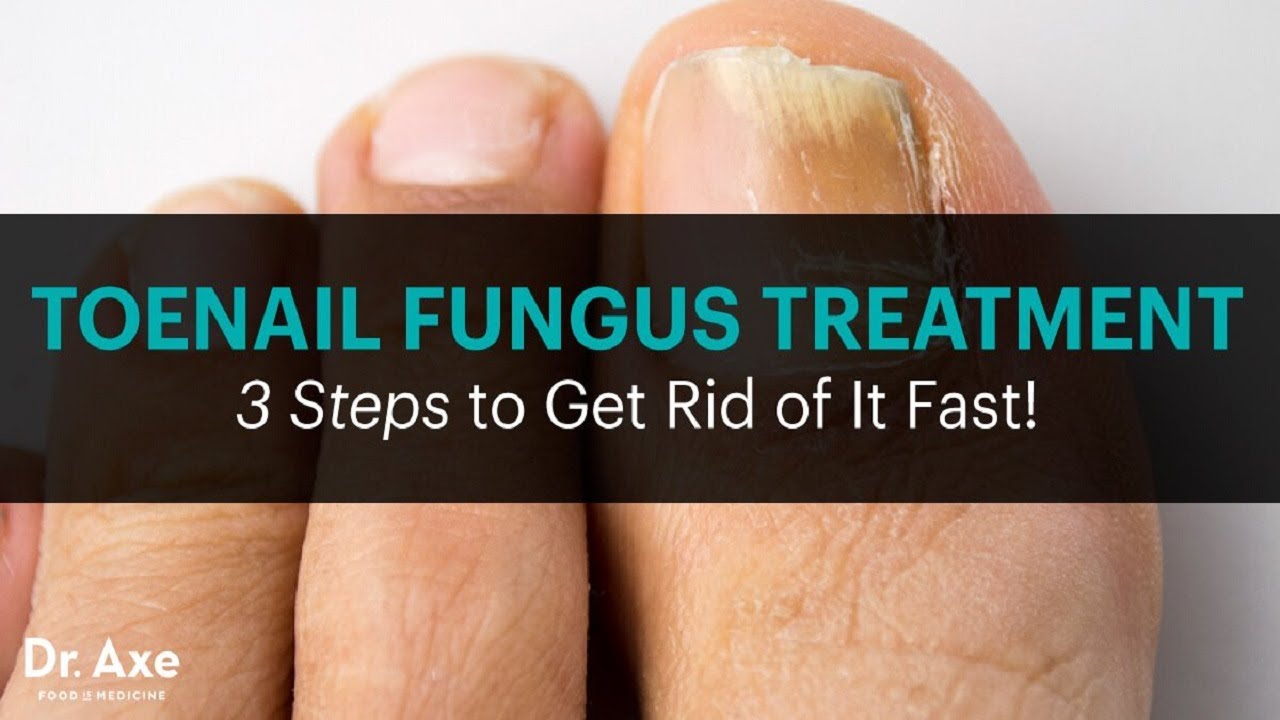 The Best Nail Fungus Treatment What Is The Best Nail Fungus Over The