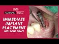 Immediate implant placement with Bone graft in left lower 1 st molar