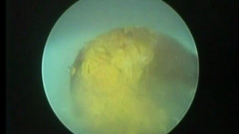 PCNL with Vibrolith PLUS video 1