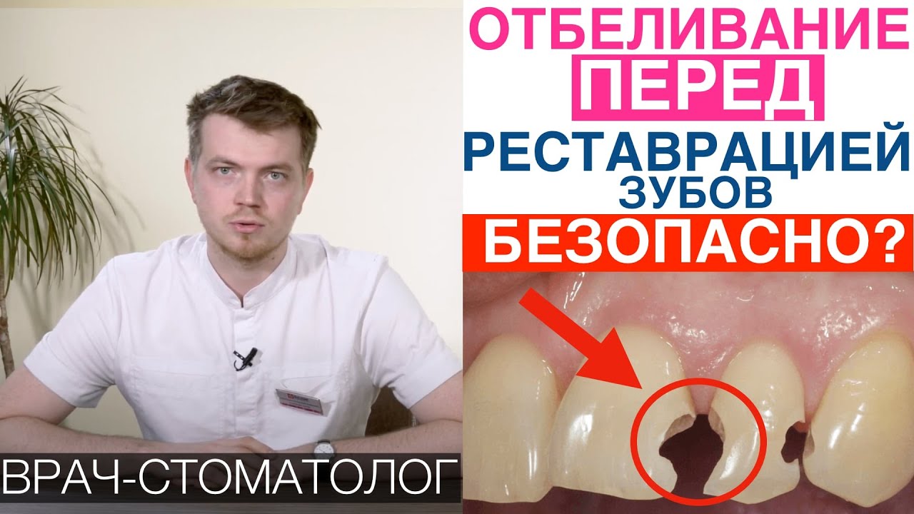 Отбеливание зубов перед реставрацией зубов - безопасно или вредно ...