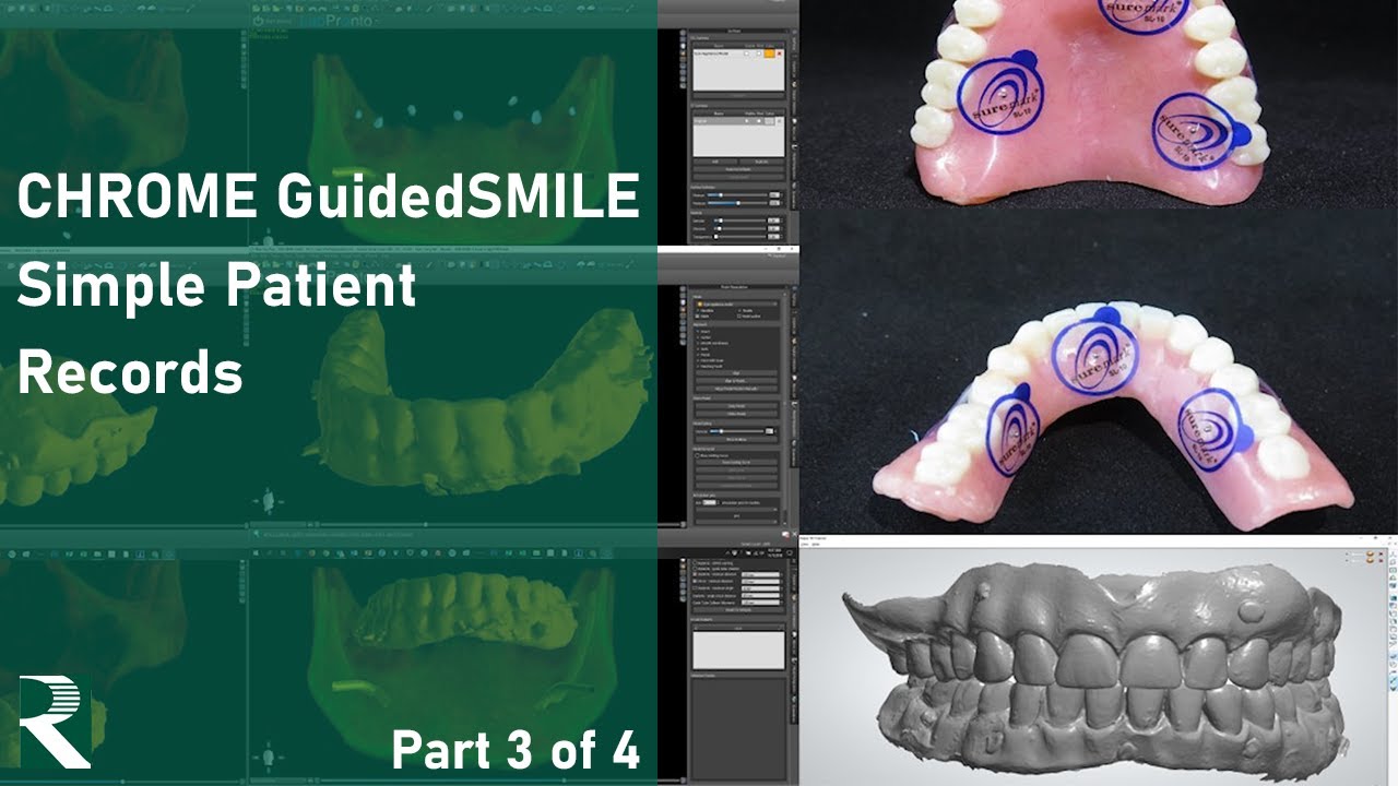 CHROME Training Videos - ROE Dental Laboratory