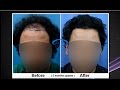 Best Hair Transplant result | Before and after video | @ Dr. A's Clinic by Dr. Arvind Poswal