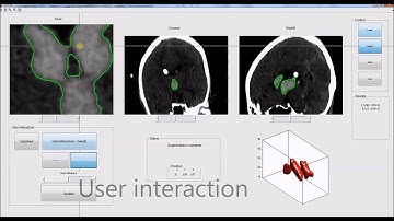 Probabilistic model for 3D interactive segmentation - Cerebral Hemorrhage in brain CT scans