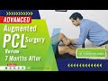  advanced augmented pcl reconstruction surgery 7month review 