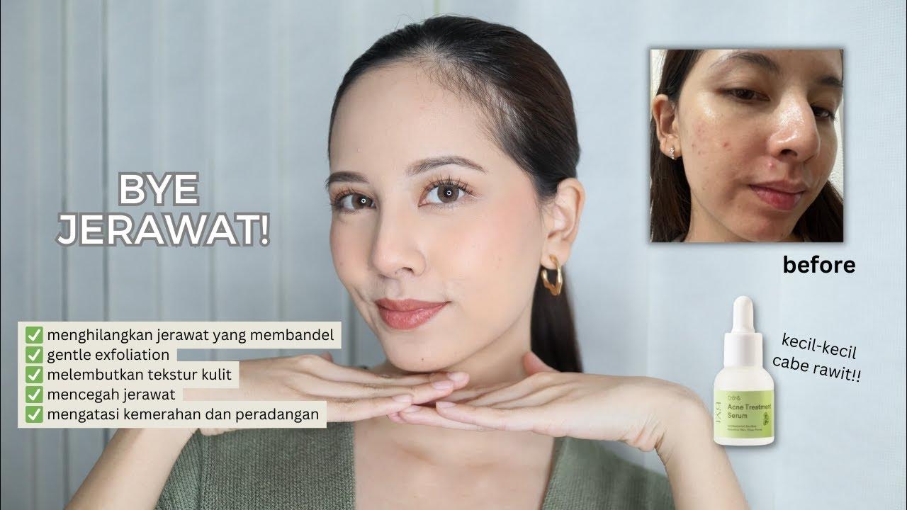 AKHIRNYA NEMU ACNE SERUM YANG COCOK DI KULIT SENSITIF! | BYT Acne