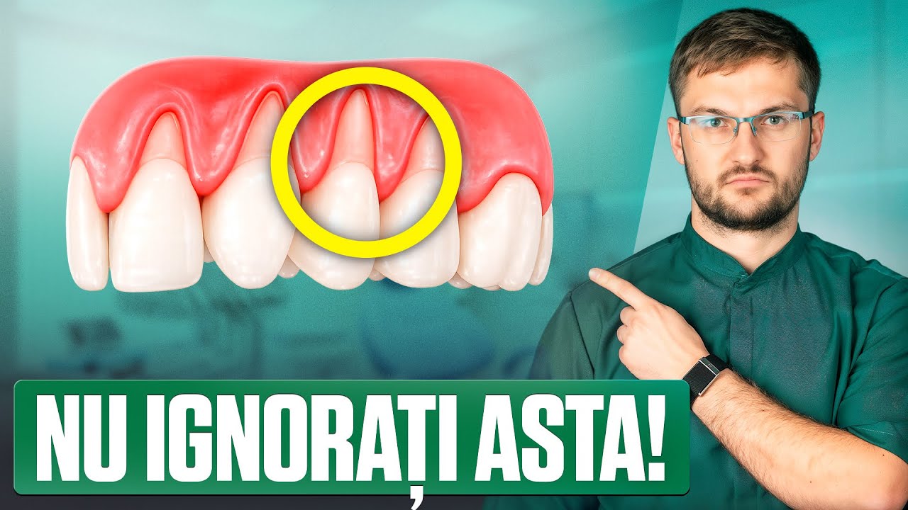 Trebuie să faceți asta dacă aveți rădăcinile dinților expuse! Cum se tratează retracția gingiilor?