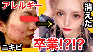 【速報】え？２年半も悩み苦しんでいたアレルギーが突然消えたんだけど。【ニキビ】