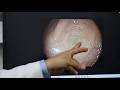 Austin Gastroenterology Introduces AI Technology To Colonoscopies At Austin Endoscopy Centers 