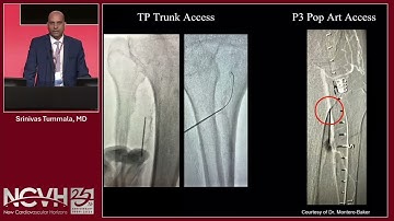 CTO Crossing Tips and Tricks