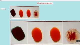 Blood Group Detection in Python Projects