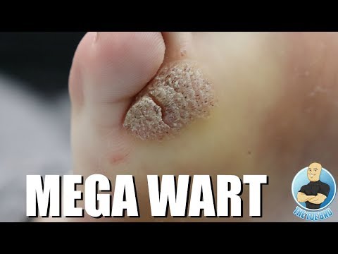 MONSTER MOSAIC WART REMOVAL