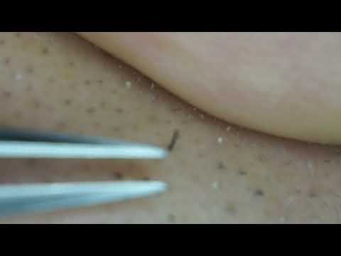 Hair removal news【UNWANTED hair ASMR 2020】20200510kill time,hair removal news,relax time,pull out
