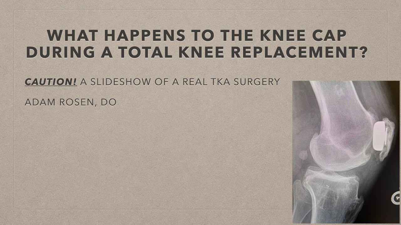 The kneecap in total knees What happens to the kneecap during a total