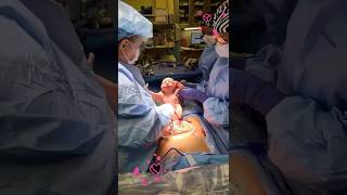 This Medically Necessary C-Section Was Followed By Vbac At Home.