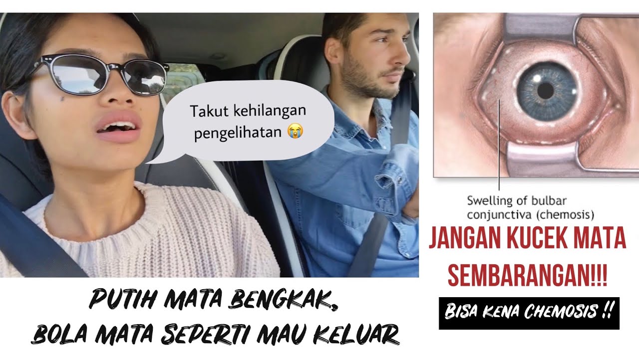 PUTIH MATA BENGKAK TIBA-TIBA, BOLA MATA SEPERTI MAU KELUAR!! JANGAN