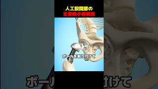 人工股関節の全置換手術解説
