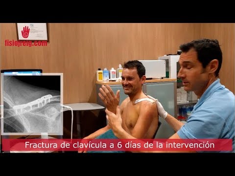 fisioterapia laser Fractura de clavícula, recuperación de Rafa Valls a los 6 días de la intervención