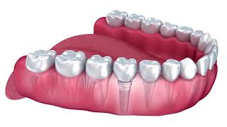 FAQ - What is a dental implant? | Sage Dental Care