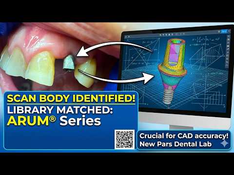 How to Choose the Right Dental Implant Scan Body for Precise Dental Implant Custom Abutments
