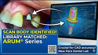 How To Choose The Right Dental Implant Scan Body For Precise Dental Implant Custom Abutments