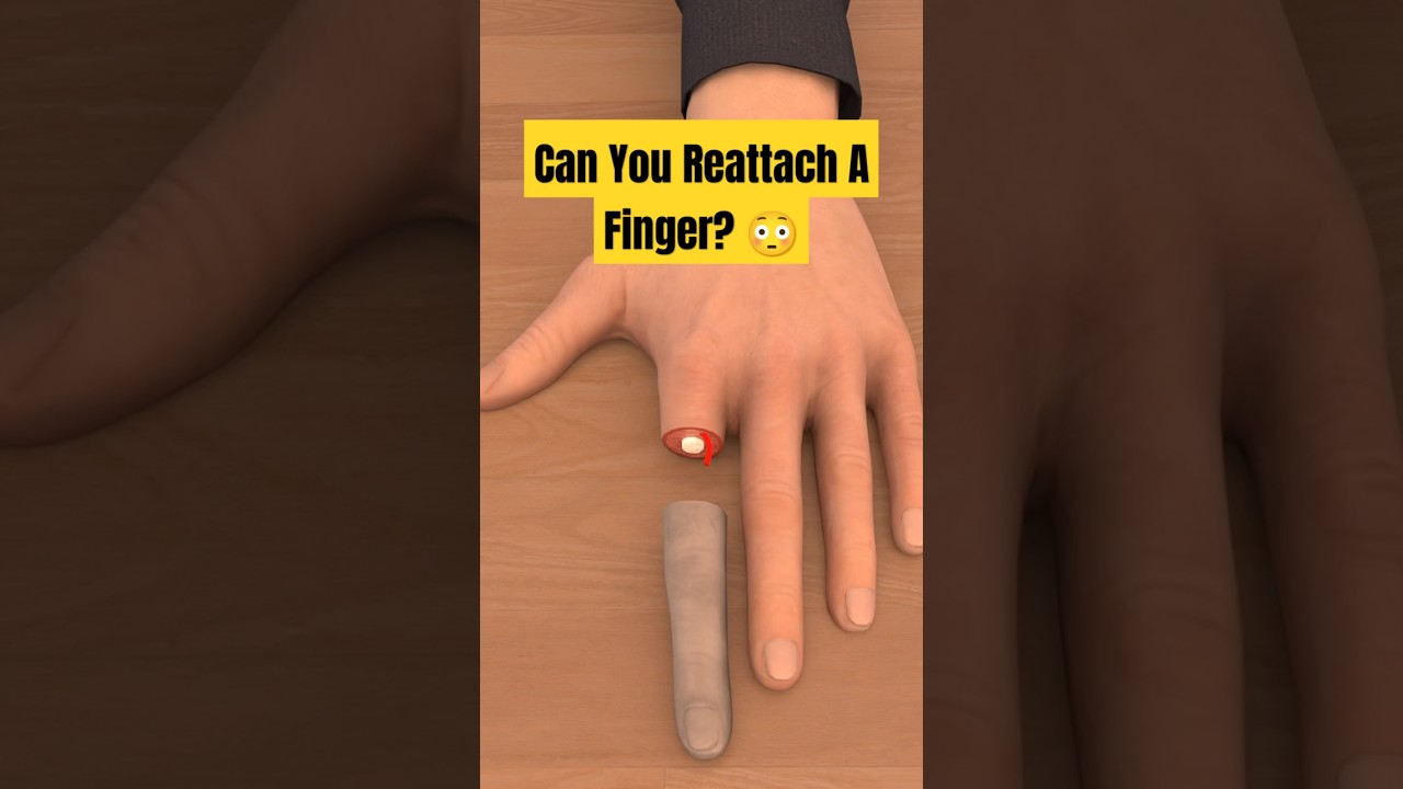 Can You Reattach a Finger? ๐ฉธ๐๏ธ