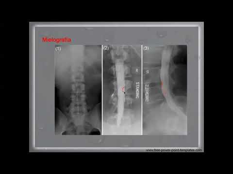 Video: ¿La mielografía requiere contraste?