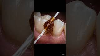 Daant ki cavity nikal di! 🧐 #satisfying #asmr teeth