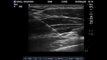 Ultrasound guided Costoclavicular Brachial Plexus Block
