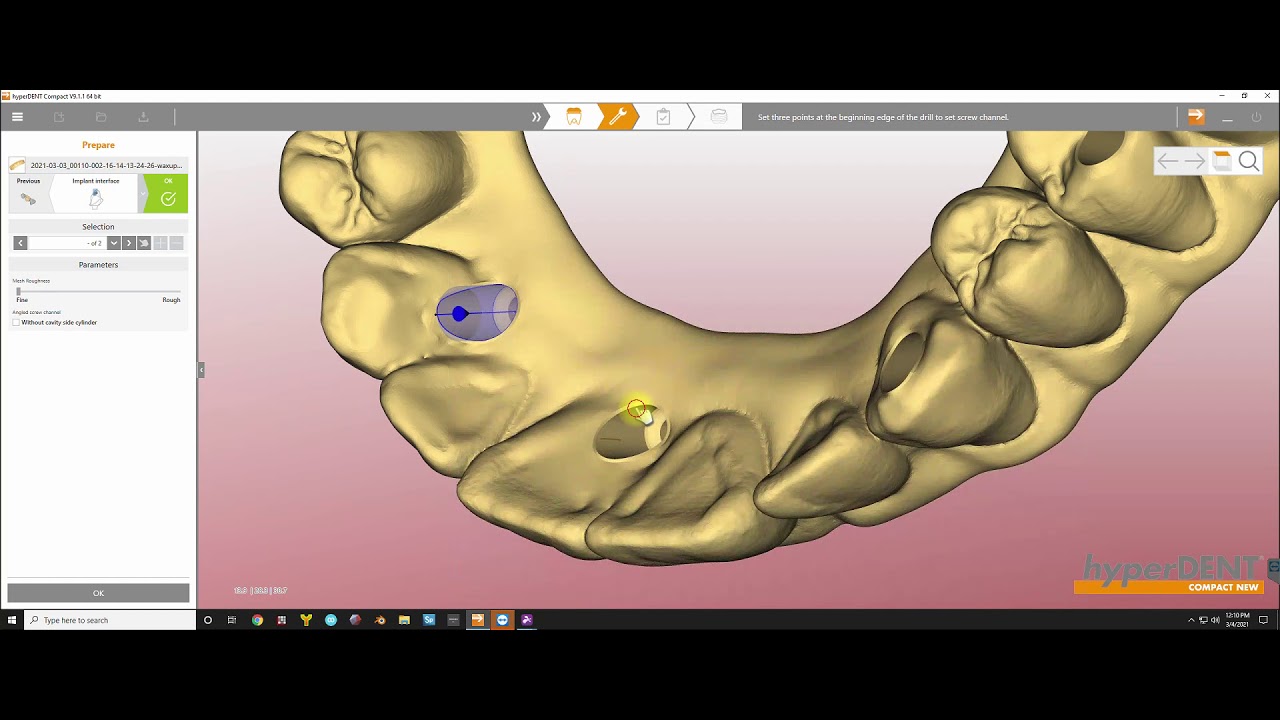 Manually Preparing A Full Arch Restoration YouTube manually-preparing-a-full-arch-restoration-youtube