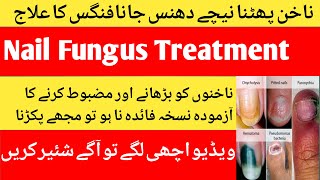 How to prevent and treat nail fungus infection/How to get rid of nail fungus/ناخنوں کا علاج/