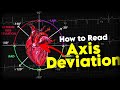 Understanding Axis Deviation in ECG - A Visual Guide