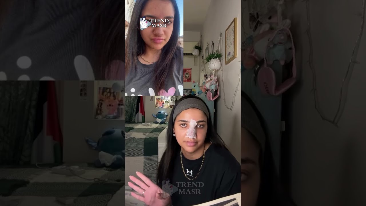 تحذير 🚨 ماحدش يحقن في منطقة المناخير .. مناخير البلوجر كنزي مدبولي كانت هتروح 💔