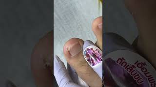 Ep8285 Ingrown Toenail Removal ถาเหงอออกเทา..ตองเคลยรหนงพวกนออก Clip From Thailand