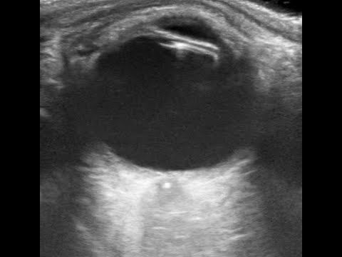 Central Retinal Artery